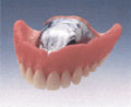 金属床義歯