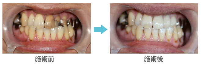 前歯部左部分1～3番の変色部分を審美的に治療した症例－e-maxによる治療
