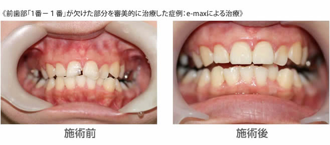 前歯部「1番－１番」が欠けた部分を審美的に治療した症例：e-maxによる治療