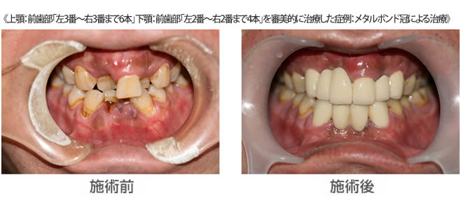 上顎：前歯部「左3番～右3番まで6本」下顎：前歯部「左2番～右2番まで4本」を審美的に治療した症例：メタルボンド冠による治療